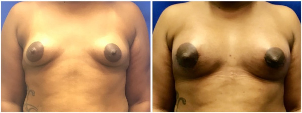 breast-augmentation-plastic-surgery-nyc-before-after-photo-1-1