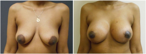 breast-augmentation-plastic-surgery-nyc-before-after-photo-2-1