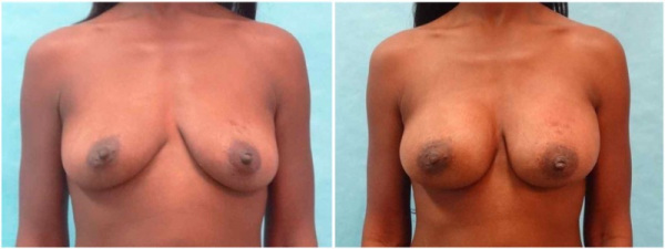 breast-augmentation-plastic-surgery-nyc-before-after-photo-3-1