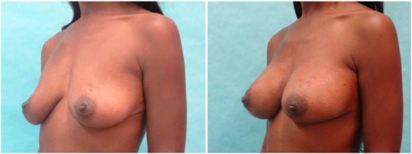 breast-augmentation-plastic-surgery-nyc-before-after-photo-3-2