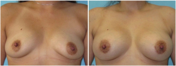 breast-augmentation-plastic-surgery-nyc-before-after-photo-5-1