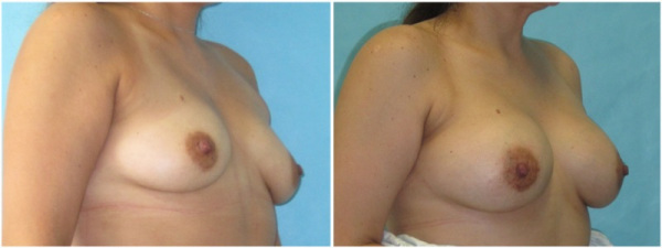 breast-augmentation-plastic-surgery-nyc-before-after-photo-5-2