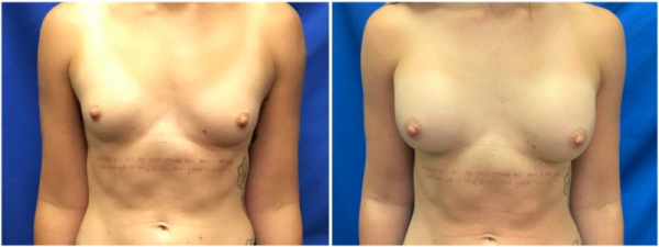 breast-augmentation-plastic-surgery-nyc-before-after-photo-6-1