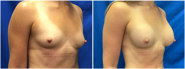 breast-augmentation-plastic-surgery-nyc-before-after-photo-6-2