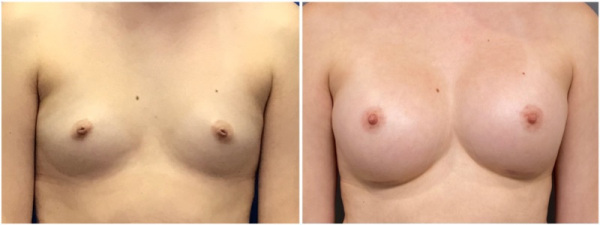 breast-augmentation-plastic-surgery-nyc-before-after-photo-7-1