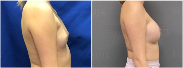 breast-augmentation-plastic-surgery-nyc-before-after-photo-7-2