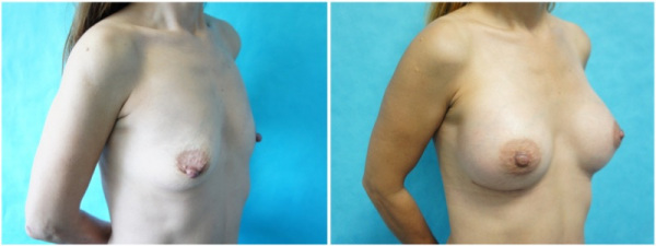 breast-augmentation-with-nipple-reduction-plastic-surgery-nyc-before-after-photo-4-1