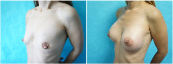 breast-augmentation-with-nipple-reduction-plastic-surgery-nyc-before-after-photo-4-2