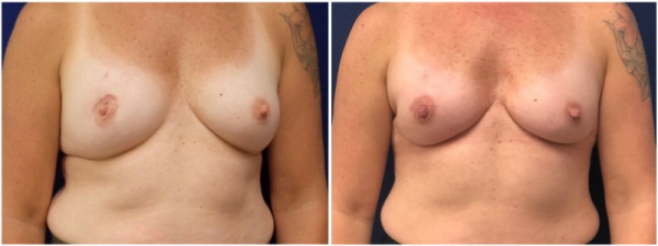 breast-reconstruction-plastic-surgery-nyc-before-after-photo-1-1