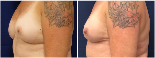 breast-reconstruction-plastic-surgery-nyc-before-after-photo-1-2