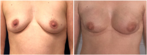 breast-reconstruction-plastic-surgery-nyc-before-after-photo-2-1