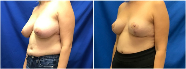 breast-reduction-plastic-surgery-nyc-before-after-photo-1