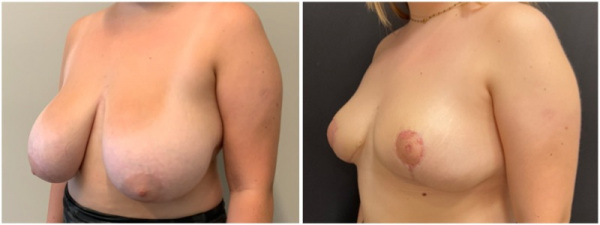 breast-reduction-plastic-surgery-nyc-before-after-photo-10-1