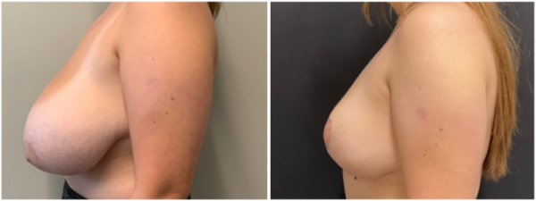 breast-reduction-plastic-surgery-nyc-before-after-photo-10-2