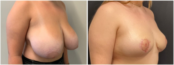 breast-reduction-plastic-surgery-nyc-before-after-photo-10-3