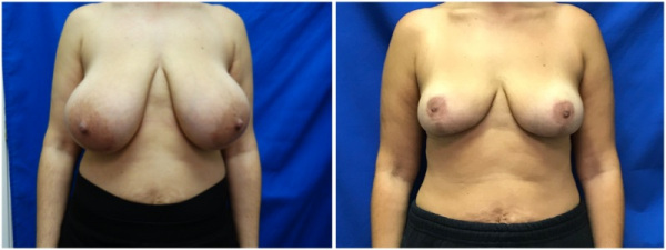 breast-reduction-plastic-surgery-nyc-before-after-photo-11-1