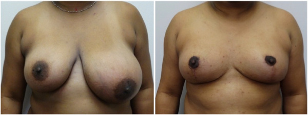 breast-reduction-plastic-surgery-nyc-before-after-photo-2