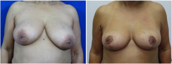 breast-reduction-plastic-surgery-nyc-before-after-photo-3-1