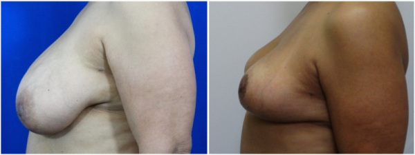 breast-reduction-plastic-surgery-nyc-before-after-photo-3-2