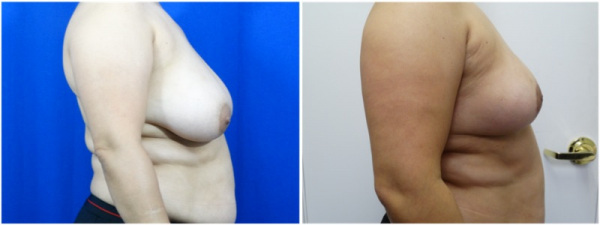 breast-reduction-plastic-surgery-nyc-before-after-photo-4-2