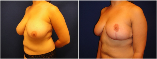 breast-reduction-plastic-surgery-nyc-before-after-photo-5-1