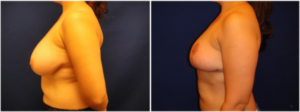 breast-reduction-plastic-surgery-nyc-before-after-photo-5-2