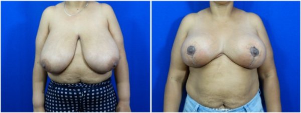 breast-reduction-plastic-surgery-nyc-before-after-photo-6-1