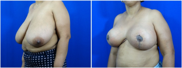 breast-reduction-plastic-surgery-nyc-before-after-photo-6-2