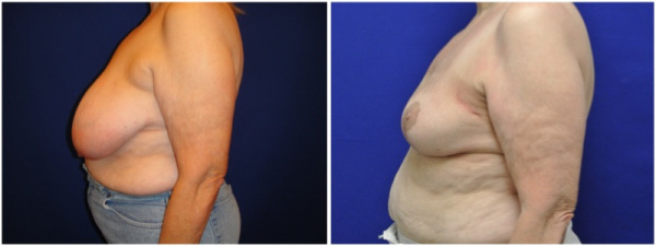 breast-reduction-plastic-surgery-nyc-before-after-photo-7-1