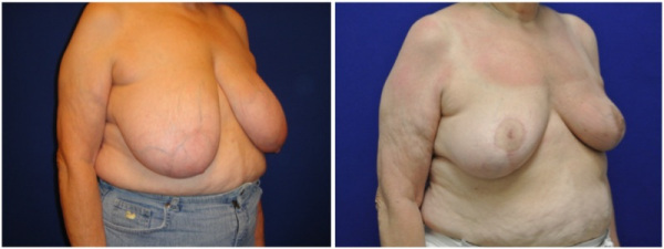 breast-reduction-plastic-surgery-nyc-before-after-photo-7-2