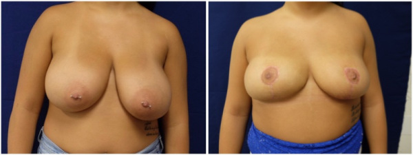 breast-reduction-plastic-surgery-nyc-before-after-photo-8