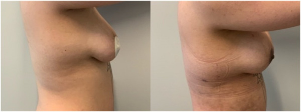 augmastopexy-plastic-surgery-nyc-before-after-photo-1